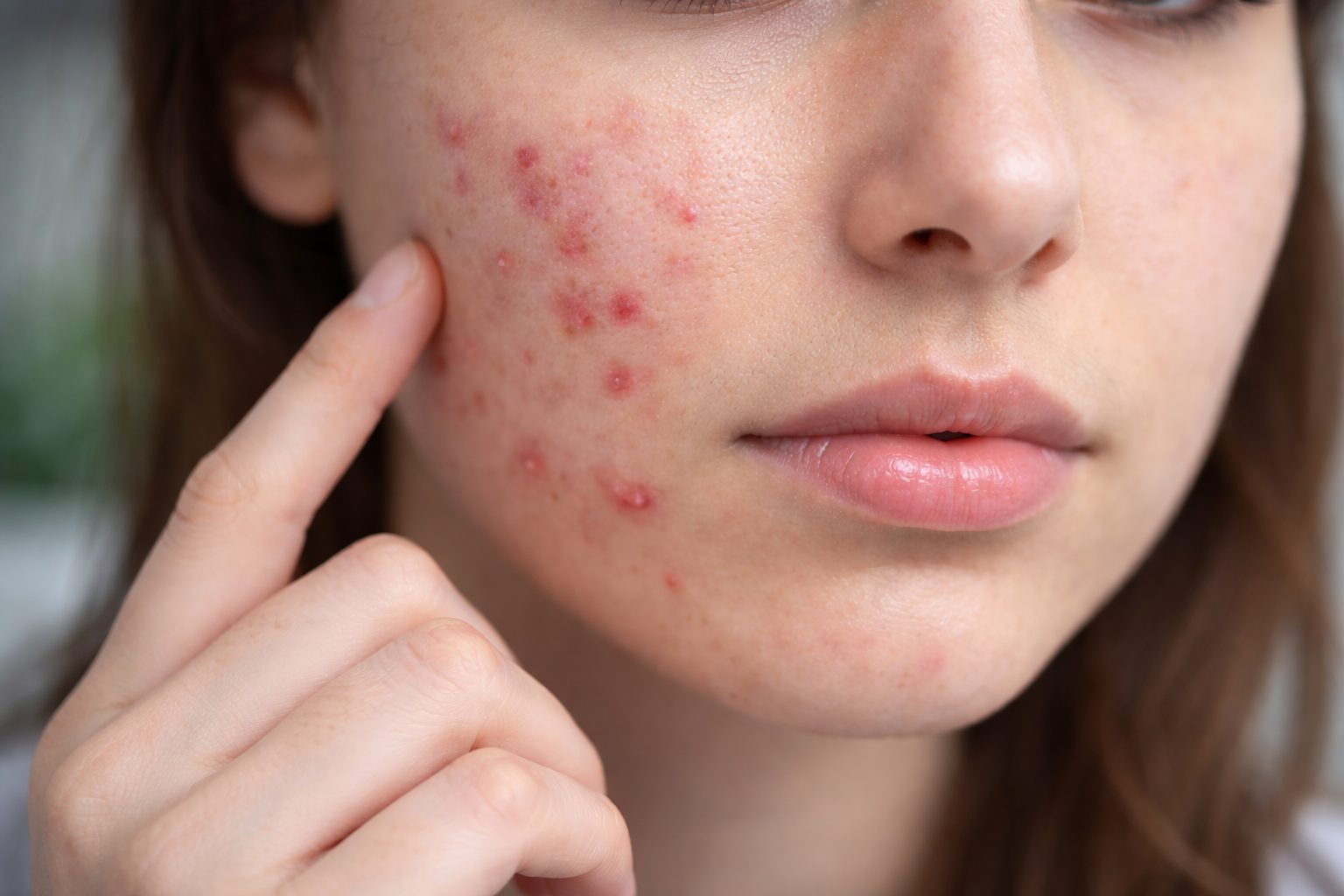 Close-up of a young woman’s cheek showing visible acne, red pimples, and inflamed blemishes on the skin, with natural lighting and a soft blurred background.